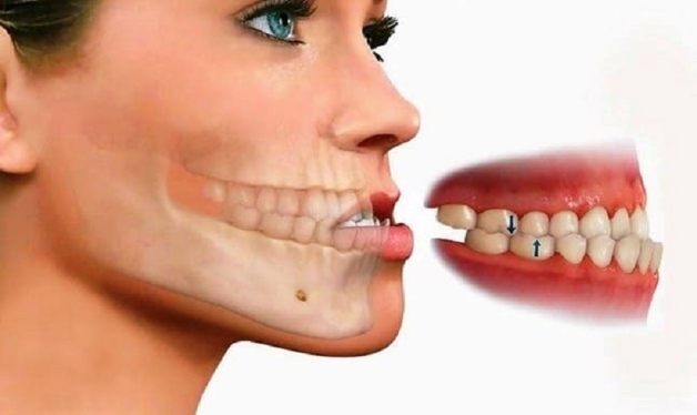 Răng bị móm