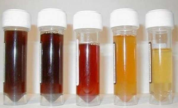 nước tiểu chuyển màu cảnh báo gan bị ung thư