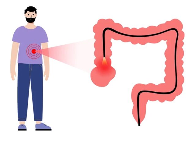 Tiên lượng và giai đoạn của ung thư đại tràng