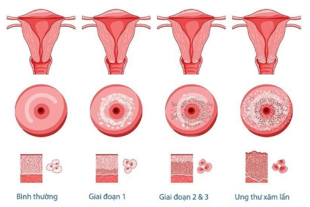 ung thư cổ tử cung có mấy giai đoạn