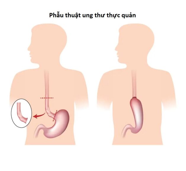 Phương pháp điều trị bệnh ung thư tại thực quản