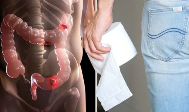 Triệu chứng của bệnh nhân mắc ung thư đại tràng giai đoạn 3