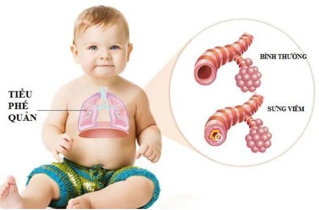 Trẻ bị viêm tiểu phế quản có nguy hiểm không?