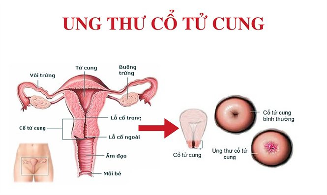UNG THƯ CỔ TỬ CUNG GIAI ĐOẠN 1 CÓ THỂ CHỮA KHỎI NẾU PHÁT HIỆN VÀ ĐIỀU TRỊ KỊP THỜI