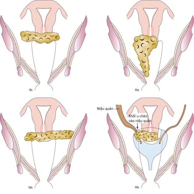 Ung thư cổ tử cung giai đoạn 3 và triển vọng