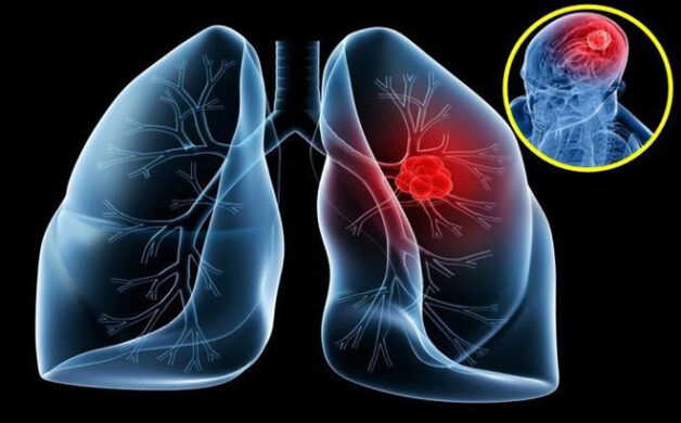 tiên lượng sống của bệnh ung thư phổi