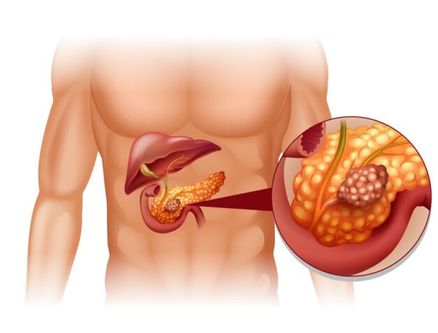 Nguyên nhân và triệu chứng của ung thư tuyến tụy