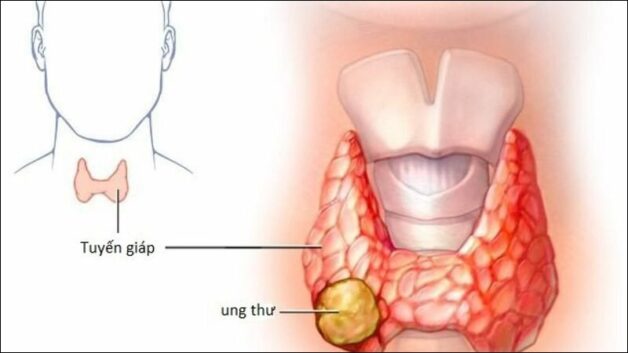 Chữa khỏi ung thư tuyến giáp với từng thể khác nhau
