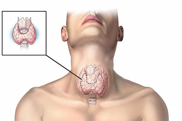 Ung thư tuyến giáp và những thông tin cần biết