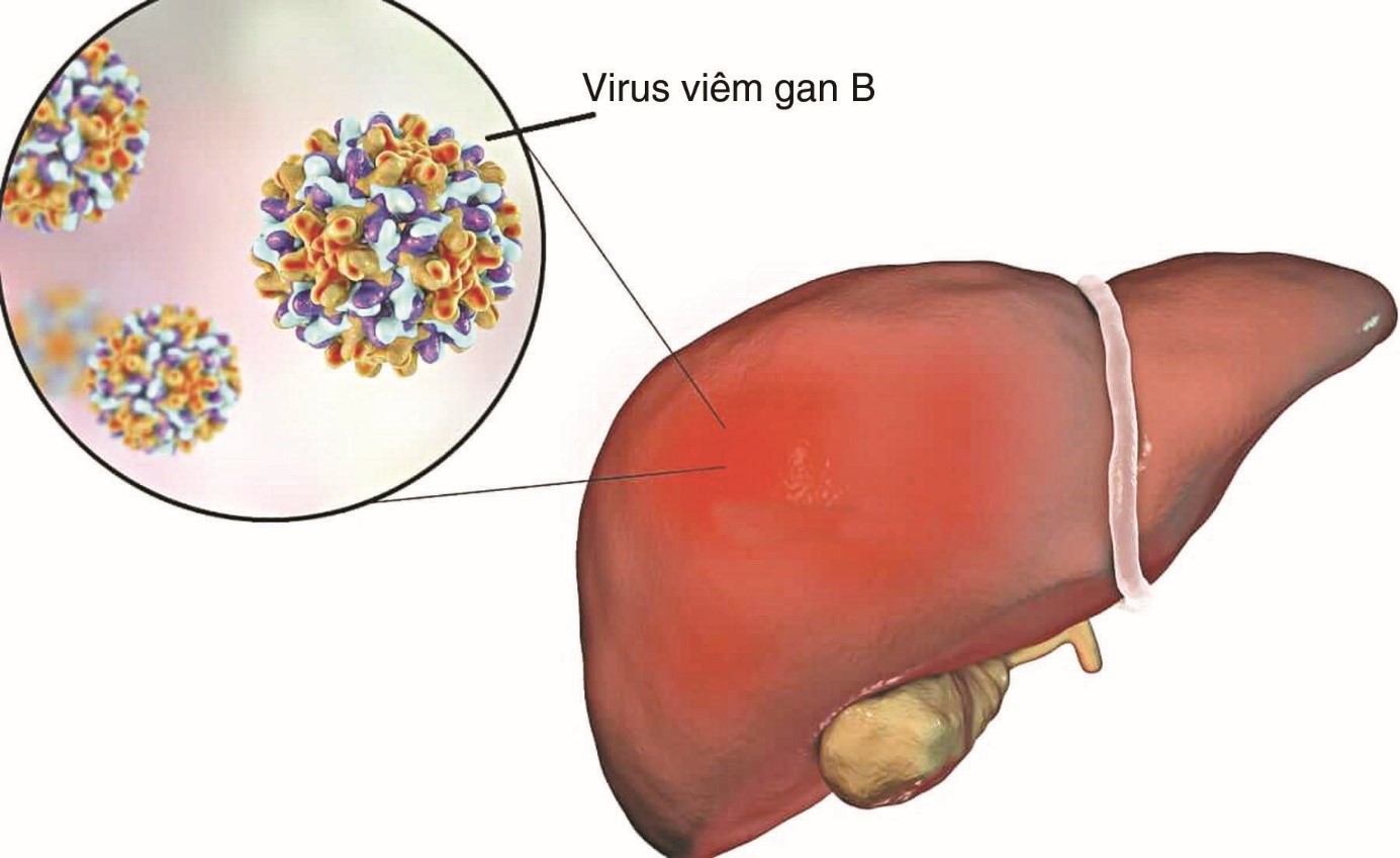 Viêm gan B là một bệnh gây tác động nghiêm trọng đến chức năng gan