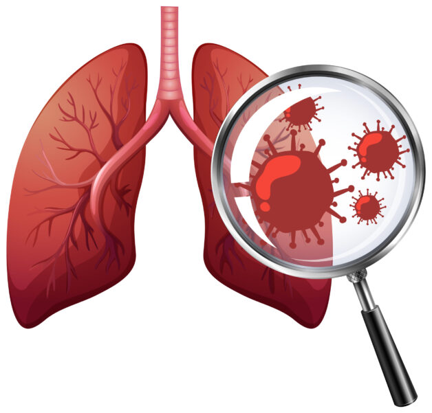 Sự tấn công của virus và vi khuẩn gây bệnh viêm phế quản.