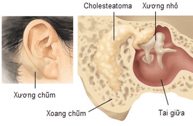 Viêm xương chũm là bệnh lý nhiễm trùng thường gặp ở đối tượng trẻ em
