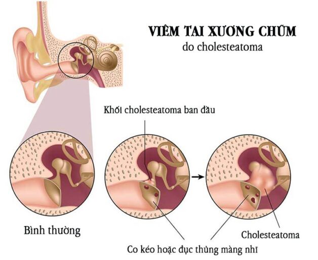 Viêm tai xương chũm có cholesteatoma là bệnh gì