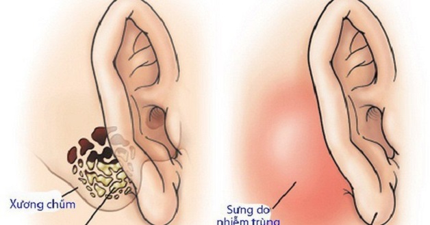 Triệu chứng Viêm tai xương chũm có cholesteatoma