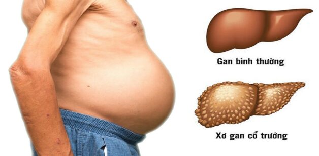 dấu hiệu xơ gan ung thư gan