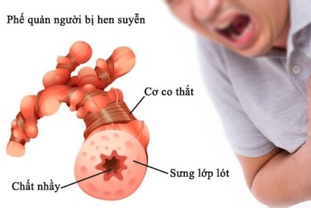bệnh hen phế quản