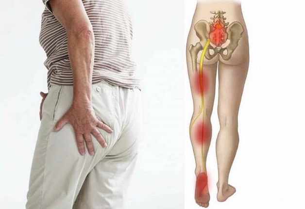 đau dây thần kinh tọa