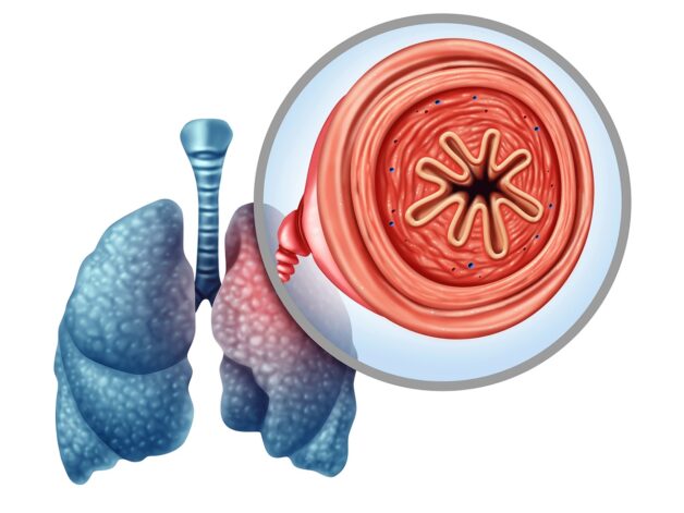 Sơ lược về bệnh phổi tắc nghẽn mạn tính COPD