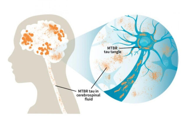 Mất kết nối não gây hội chứng Alzheimer