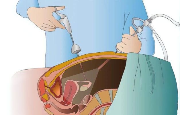 Mổ u tuyến thượng thận có nguy hiểm không là câu hỏi nhiều người thắc mắc