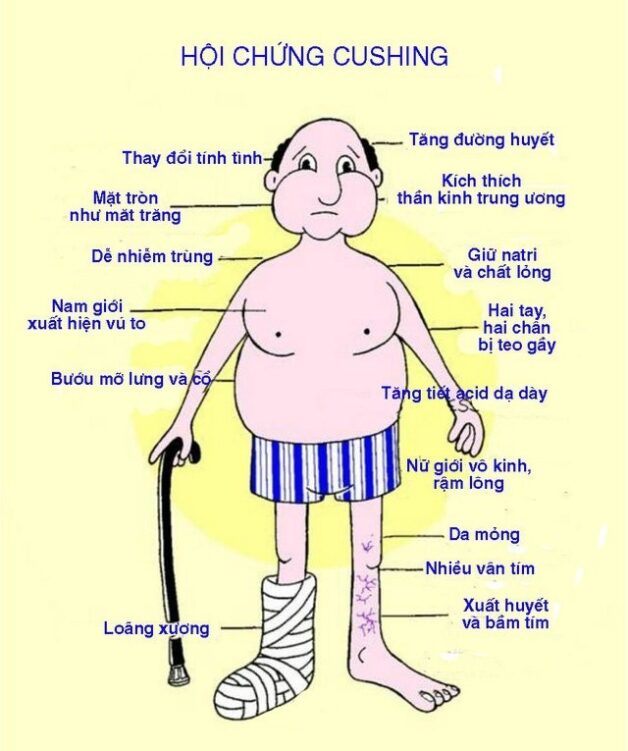 U tuyến thượng thận gây tăng huyết áp gây bệnh cushing