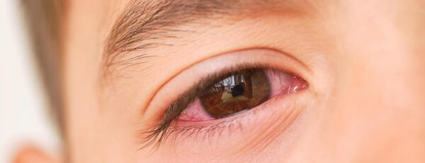 Tìm hiểu về bệnh đau mắt đỏ là gì?