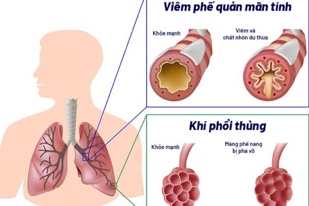 bệnh copd