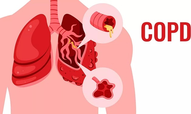 bệnh tắc nghẽn phổi mãn tính