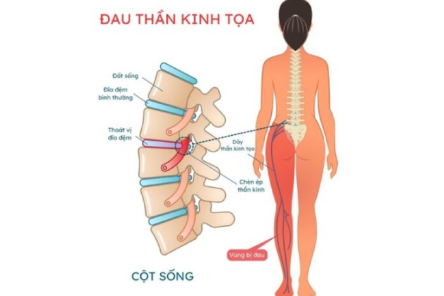 bị đau dây thần kinh tọa