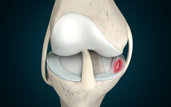 Rách sụn chêm đầu gối có thể tự lành không?