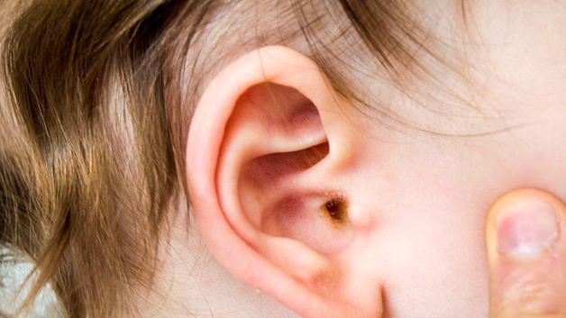 Bệnh viêm tai giữa ở trẻ không lây lan cho mọi người xung quanh