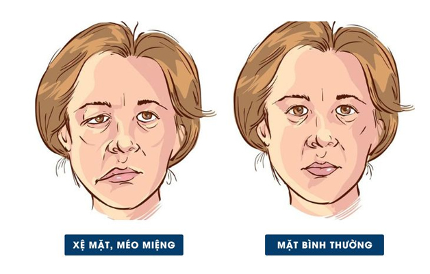 Cách nhận biết dấu hiệu đột quỵ - quan sát sự mất cân đối giữa 2 bên mặt người bệnh.