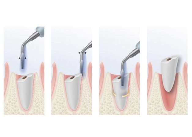 Hiệu quả của cách nhổ răng không đau