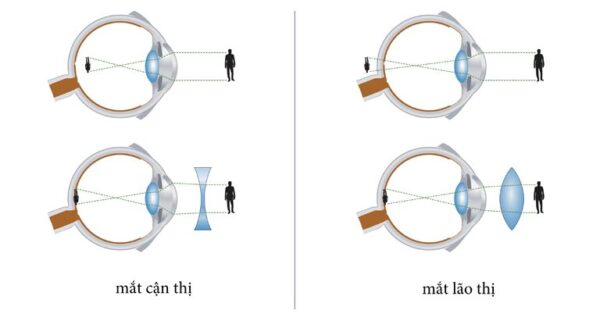 Khái niệm của lão thị và cận thị là gì?