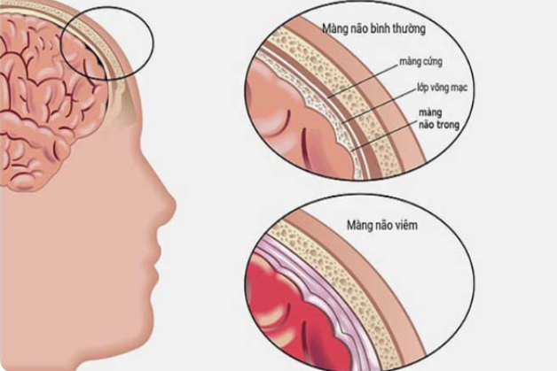 viêm màng não mủ