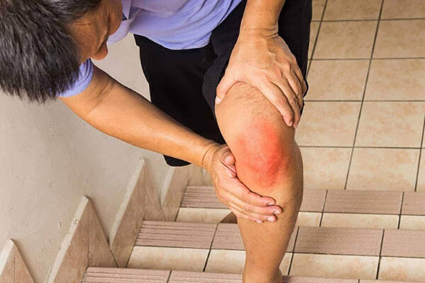 Dấu hiệu đứt dây chằng đầu gối
