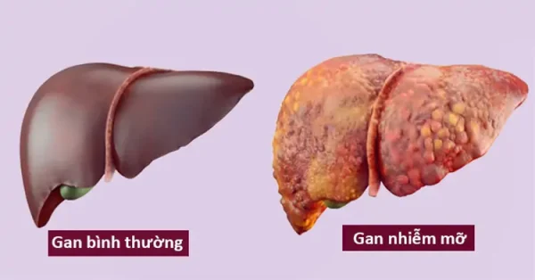 Gan nhiễm mỡ khi nào?