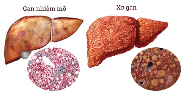Gan nhiễm mỡ là gì?
