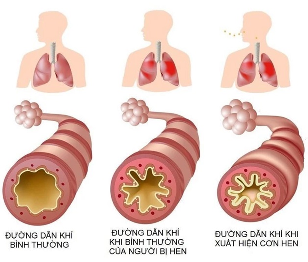 hen phế quản khó thở