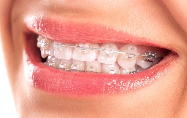 Kỹ thuật niềng răng mắc cài