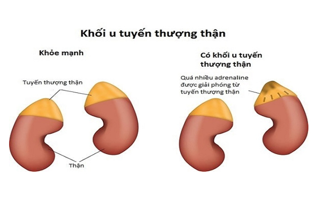 Minh họa tuyến thượng thận bình thường và tuyến thượng thận có u.