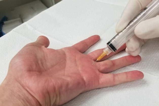 Viêm gân gấp ngón tay