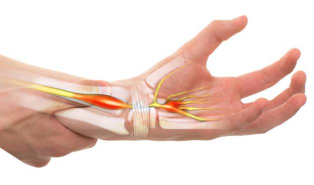 Hiểu rõ về căn bệnh hội chứng ống cổ tay