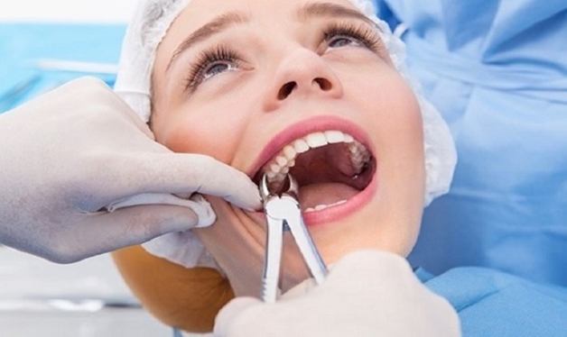 Phương pháp nhổ răng số 8 hàm trên