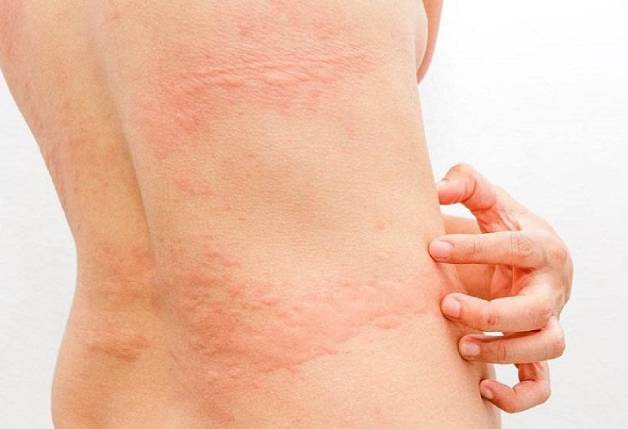 Các triệu chứng lâm sàng khi nhiễm sán lá gan