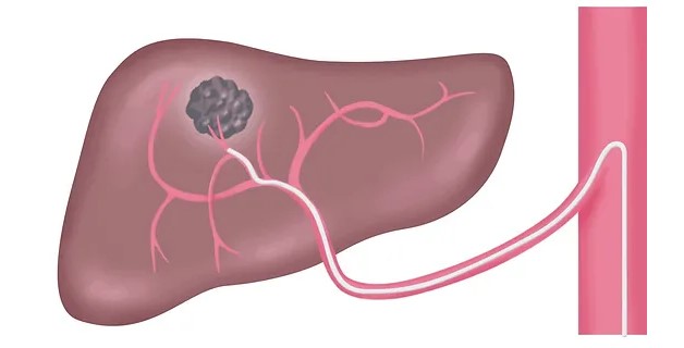 Kỹ thuật nút mạch trong điều trị ung thư gan