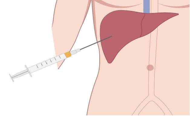 Tại sao cần sinh thiết gan?