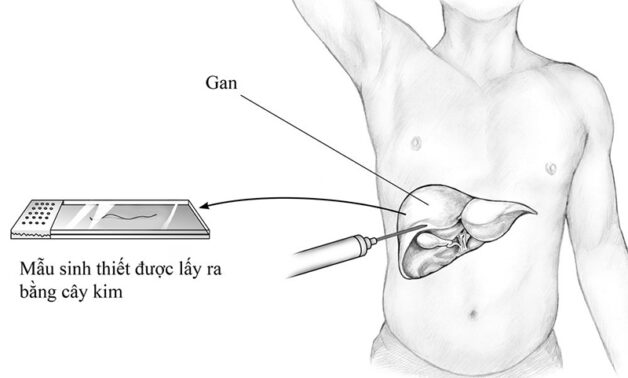kỹ thuật sinh thiết gan