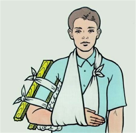 Sử dụng phương pháp băng treo để cố định xương đòn gãy