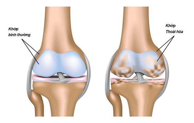 thay khớp nhân tạo